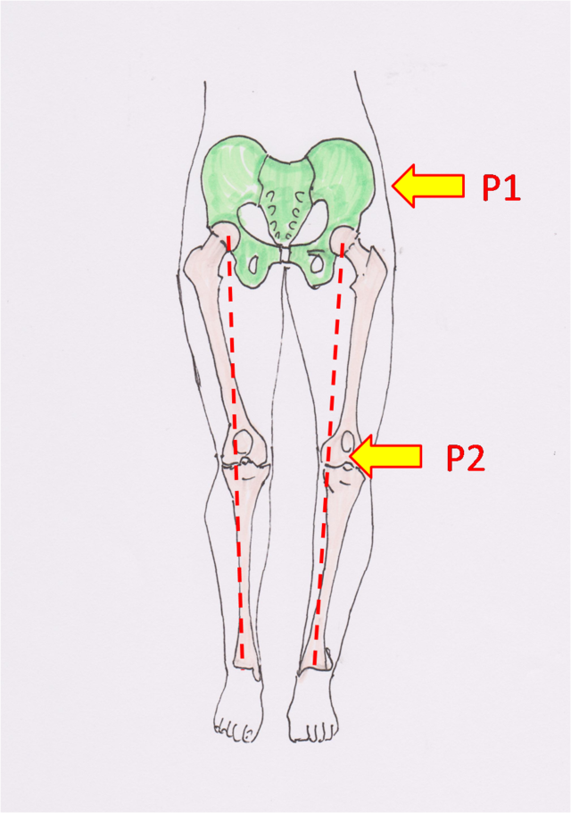 骨盤のゆがみと膝の痛みの解説画像